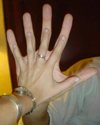 basketball player chris christopherson hand